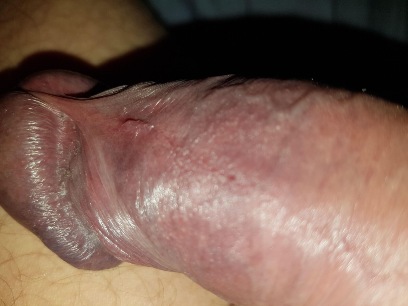 Swollen glans